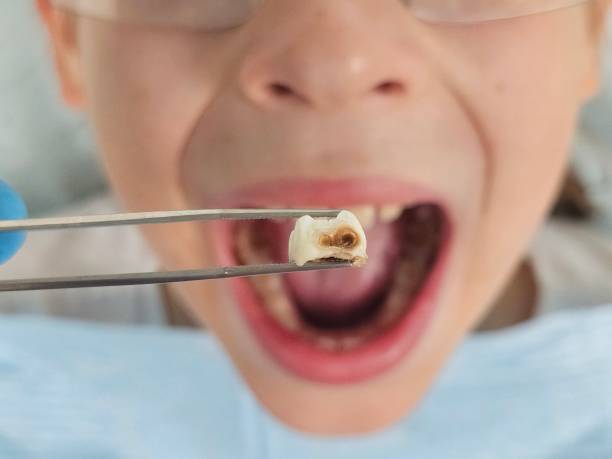 Best Broken Tooth Emergency  in Poulsbo, WA